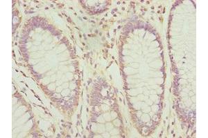 Immunohistochemistry of paraffin-embedded human colon cancer using ABIN7164691 at dilution of 1:100