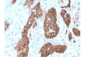 Formalin-fixed, paraffin-embedded human Breast Carcinoma stained with PDZ and LIM Domain 1 Mouse Monoclonal Antibody (PDLIM-1). (PDLIM1 antibody)