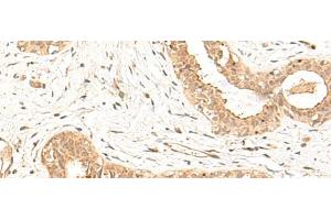 Immunohistochemistry of paraffin-embedded Human breast cancer tissue using FBXL4 Polyclonal Antibody at dilution of 1:25(x200) (FBXL4 antibody)