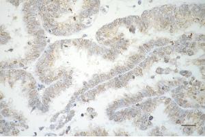 Immunohistochemistry was performed on paraffin-embedded human ovarian carcinoma using RAD51 recombinase antibody (ABIN7798367), 1:200). (Recombinant RAD51 antibody)