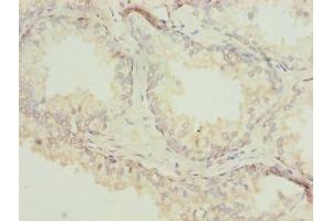 Immunohistochemistry of paraffin-embedded human prostate cancer using ABIN7143059 at dilution of 1:100 (Actl7b antibody  (AA 1-415))