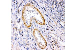 Anti- Calretinin Picoband antibody, IHC(P) IHC(P): Human Intestinal Cancer Tissue (Calretinin antibody  (C-Term))