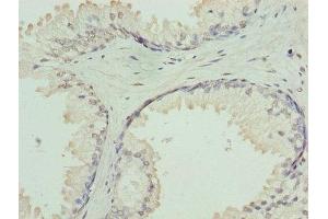 Immunohistochemistry of paraffin-embedded human prostate cancer using ABIN7154735 at dilution of 1:100 (GNa14 antibody  (AA 8-303))