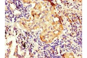 Immunohistochemistry of paraffin-embedded human lung cancer using ABIN7161015 at dilution of 1:100 (NOXA1 antibody  (AA 150-313))