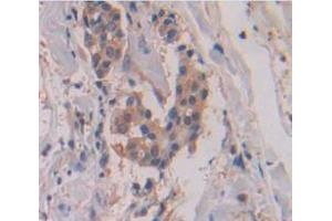 IHC-P analysis of Human Tissue, with DAB staining. (MMP13 antibody  (AA 290-468))