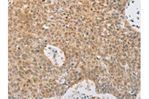 The image on the left is immunohistochemistry of paraffin-embedded Human lung cancer tissue using ABIN7131039(SERPINE2 Antibody) at dilution 1/20, on the right is treated with fusion protein. (SERPINE2 antibody)