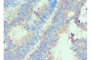 Immunohistochemistry of paraffin-embedded human colon cancer using ABIN7155937 at dilution of 1:100 (HIP1 antibody  (AA 410-690))