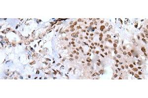 Immunohistochemistry of paraffin-embedded Human liver cancer tissue using XAB2 Polyclonal Antibody at dilution of 1:25(x200) (XAB2 antibody)