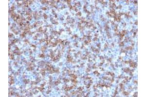 Immunohistochemical staining (Formalin-fixed paraffin-embedded sections) of human lymphoma with CD8A recombinant monoclonal antibody, clone C8/1779R . (Recombinant CD8 alpha antibody)