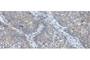 Immunohistochemistry of paraffin-embedded Human liver cancer tissue using BICD2 Polyclonal Antibody at dilution of 1:70(x200) (BICD2 antibody)