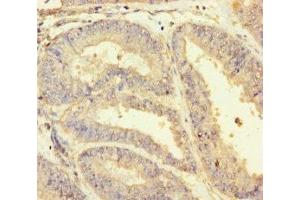 Immunohistochemistry of paraffin-embedded human endometrial cancer using ABIN7154855 at dilution of 1:100 (HSPA12B antibody  (AA 201-500))