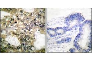 Immunohistochemistry analysis of paraffin-embedded human colon carcinoma tissue, using HDAC6 Antibody.