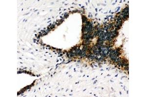 IHC-P: Annexin VII antibody testing of human breast cancer tissue (Annexin VII antibody  (C-Term))