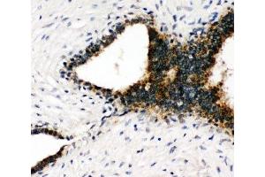 IHC-P: Annexin VII antibody testing of human breast cancer tissue