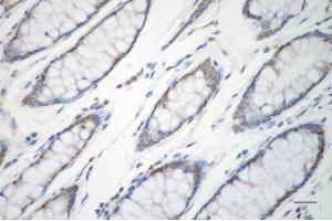 Immunohistochemistry was performed on paraffin-embedded human sigmoid colon carcinoma using ERK1 antibody (ABIN7799449), 1:200). (Recombinant ERK1 antibody)