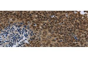Immunohistochemistry of paraffin-embedded Human cervical cancer using SMAD4 Polyclonal Antibody at dilution of 1/40 (SMAD4 antibody)