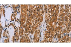 Immunohistochemistry of paraffin-embedded Human thyroid cancer tissue using ADAMTS15 Polyclonal Antibody at dilution 1:40