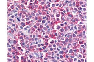 Anti-BEST2 / Bestrophin-2 antibody IHC of human Lymph Node, Non-Hodgkins Lymphoma. (Bestrophin 2 antibody  (Internal Region))