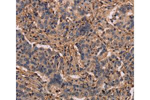 Immunohistochemistry of Human prostate cancer using MAP1LC3C Polyclonal Antibody at dilution of 1:40 (LC3C antibody)