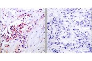 Immunohistochemistry analysis of paraffin-embedded human breast carcinoma, using NF-kappaB p65 (Phospho-Ser468) Antibody. (NF-kB p65 antibody  (pSer468))