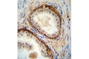Immunohistochemistry analysis in formalin fixed and paraffin embedded human prostate carcinoma reacted with NUDT8 Antibody (N-term) followed by peroxidase conjugation of the secondary antibody and DAB staining. (NUDT8 antibody  (N-Term))