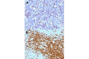 Immunohistochemical staining (Formalin-fixed paraffin-embedded sections) of human lymphoma (A) and human tonsil (B) with SPN monoclonal antibody, clone SPN/1094 . (CD43 antibody)
