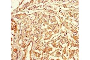 Immunohistochemistry of paraffin-embedded human pancreatic cancer using ABIN7171887 at dilution of 1:100 (Tetraspanin 7 antibody  (AA 113-223))