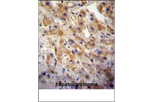 MET/HGFR Antibody (ABIN387742 and ABIN2838000) immunohistochemistry analysis in formalin fixed and paraffin embedded human hepatocarcinoma followed by peroxidase conjμgation of the secondary antibody and DAB staining. (c-MET antibody  (Catalytic Domain))