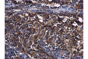 IHC-P Image STAT2 antibody [C2C3], C-term detects STAT2 protein at cytoplasm in human endometrial carcinoma by immunohistochemical analysis. (STAT2 antibody  (C-Term))
