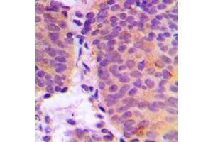 Immunohistochemical analysis of CHSY2 staining in human breast cancer formalin fixed paraffin embedded tissue section. (CHPF antibody  (C-Term))