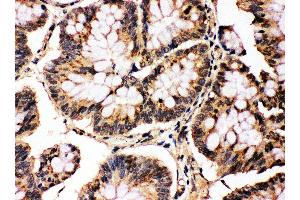 Anti-MAPK8/9 antibody, IHC(P) IHC(P): Human Intestinal Cancer Tissue (JNK antibody  (Middle Region))