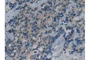 IHC-P analysis of Human Thyroid cancer Tissue, with DAB staining. (GAS6 antibody  (AA 136-311))