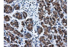 Immunohistochemical staining of paraffin-embedded Carcinoma of liver tissue using anti-BIRC7mouse monoclonal antibody. (BIRC7 antibody)