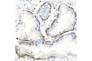 Immunohistochemistry of paraffin-embedded human prostate using BMP5 antibody. (BMP5 antibody  (AA 317-454))