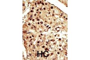 Formalin-fixed and paraffin-embedded human cancer tissue reacted with the primary antibody, which was peroxidase-conjugated to the secondary antibody, followed by DAB staining. (TRPM7 antibody  (C-Term))