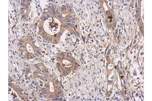 IHC-P Image Immunohistochemical analysis of paraffin-embedded human colon carcinoma, using ATIC, antibody at 1:100 dilution. (ATIC antibody)