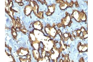 Formalin-fixed, paraffin-embedded human Angiosarcoma stained with CD34 Monoclonal Antibody (QBEnd/10 + HPCA1/763) (CD34 antibody)