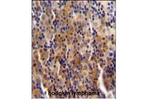 SYNE3 antibody (C-term) (ABIN654777 and ABIN2844458) immunohistochemistry analysis in formalin fixed and paraffin embedded human hodgkin lymphoma followed by peroxidase conjugation of the secondary antibody and DAB staining. (Nesprin3 antibody  (C-Term))