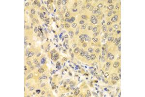 Immunohistochemistry of paraffin-embedded human liver cancer using IRF3 antibody (ABIN4904080) at dilution of 1:100 (40x lens).