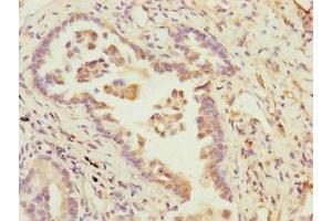 Immunohistochemistry of paraffin-embedded human lung cancer using ABIN7145189 at dilution of 1:100 (B9D2 antibody  (AA 1-175))