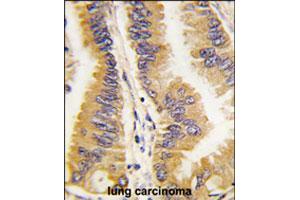 Formalin-fixed and paraffin-embedded human lung carcinoma tissue reacted with FRAT1 polyclonal antibody  , which was peroxidase-conjugated to the secondary antibody, followed by DAB staining.