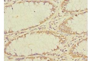 Immunohistochemistry of paraffin-embedded human colon cancer using ABIN7173139 at dilution of 1:100 (FAM156A antibody  (AA 251-519))
