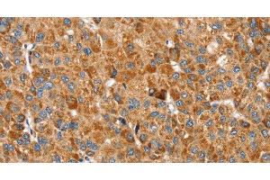 Immunohistochemistry of paraffin-embedded Human liver cancer using SSBP1 Polyclonal Antibody at dilution of 1:30 (SSBP1 antibody)