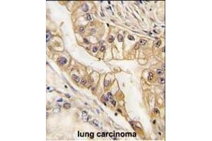 Formalin-fixed and paraffin-embedded human lung carcinoma tissue reacted with EPHB2 Monoclonal Antibody (ABIN387812 and ABIN2843903) , which was peroxidase-conjugated to the secondary antibody, followed by DAB staining. (EPH Receptor B2 antibody)