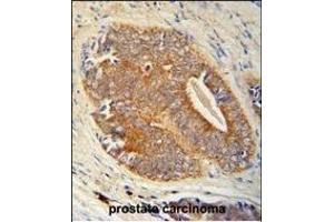 GAGE7 Antibody (C-term) (ABIN653712 and ABIN2843026) immunohistochemistry analysis in formalin fixed and paraffin embedded human prostate carcinoma followed by peroxidase conjugation of the secondary antibody and DAB staining. (G Antigen 7 antibody  (C-Term))