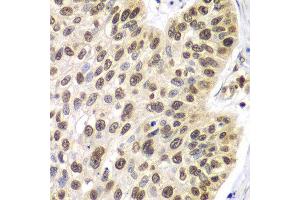 Immunohistochemistry of paraffin-embedded human lung cancer using 42254 antibody at dilution of 1:100 (x40 lens).
