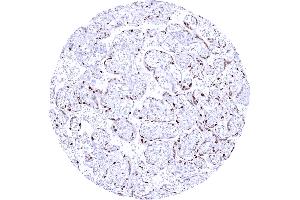 Mature placenta showing a strong Cyclin E1 staining of most cytotrophoblast cells