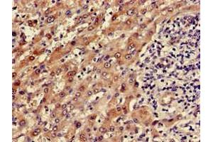 Immunohistochemistry of paraffin-embedded human liver cancer using ABIN7143656 at dilution of 1:100 (ADH5 antibody  (AA 14-130))
