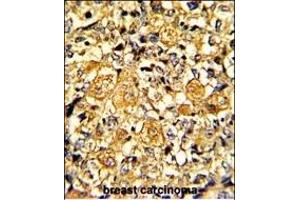 Formalin-fixed and paraffin-embedded human breast carcinoma with EGFR Monoclonal Antibody, which was peroxidase-conjugated to the secondary antibody, followed by DAB staining. (EGFR antibody)