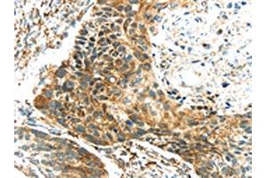 The image on the left is immunohistochemistry of paraffin-embedded Human esophagus cancer tissue using ABIN7131341(TGM4 Antibody) at dilution 1/20, on the right is treated with fusion protein. (TGM4 antibody)